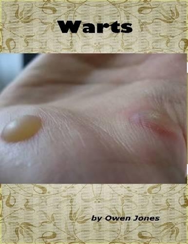 Warts
