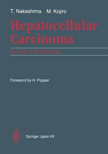 Hepatocellular Carcinoma