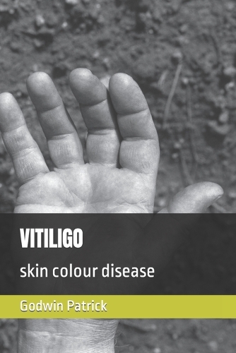Vitiligo