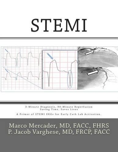 Stemi