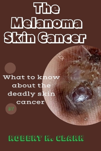 The Melanoma Skin Cancer