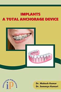 Implants - A Total Anchorage Device