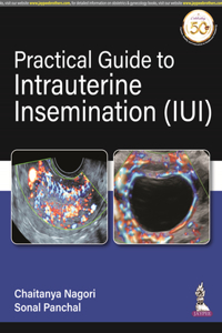 Practical Guide to Intrauterine Insemination (IUI)