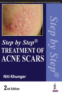 Step by Step Treatment of Acne Scars