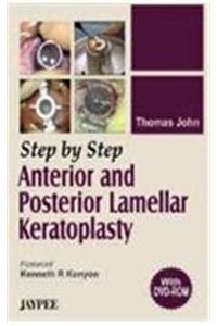 Step by Step Anterior and Posterior Lamellar Keratoplasty (with DVD-ROM)