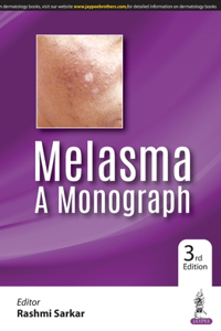 Melasma: A Monograph