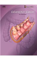 Colorectal Cancer