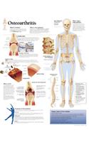 Understanding Osteoarthritis Chart