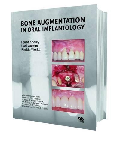 Bone Augmentation in Oral Implantology