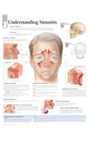 Understanding Sinusitis Chart