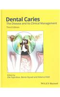 Dental Caries